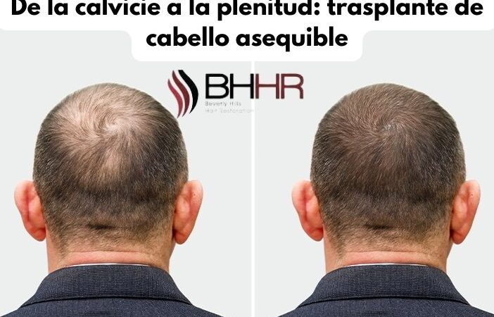 De la calvicie a la plenitud: trasplante de cabello asequible